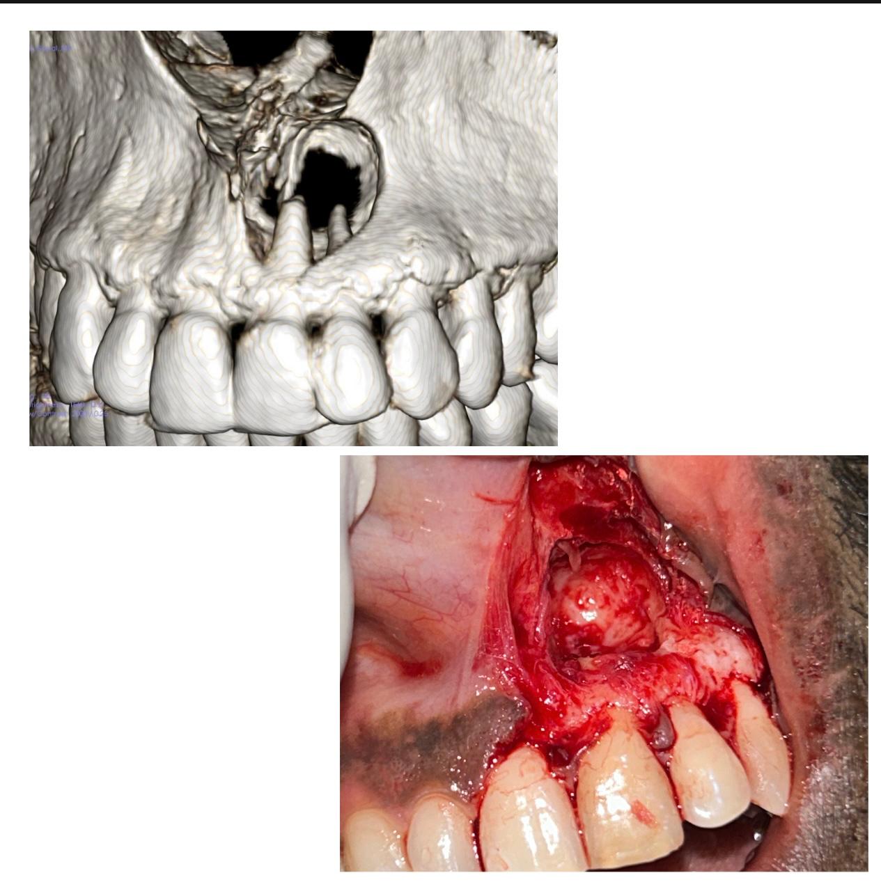 Cyst & tumor Treatment in Wakad, PCMC Dr patil elite smile dental clinic dr. mayank patil