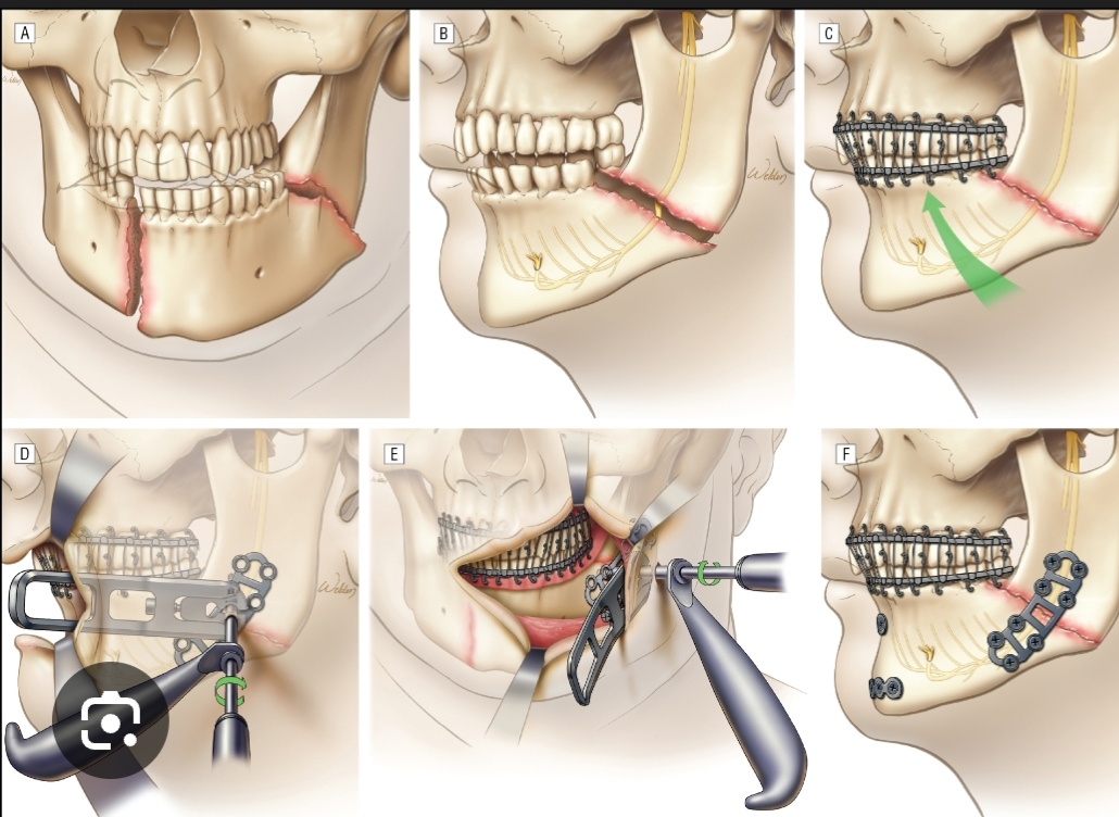 facial bone fractural wakad dr.patils elite smile dental clinic