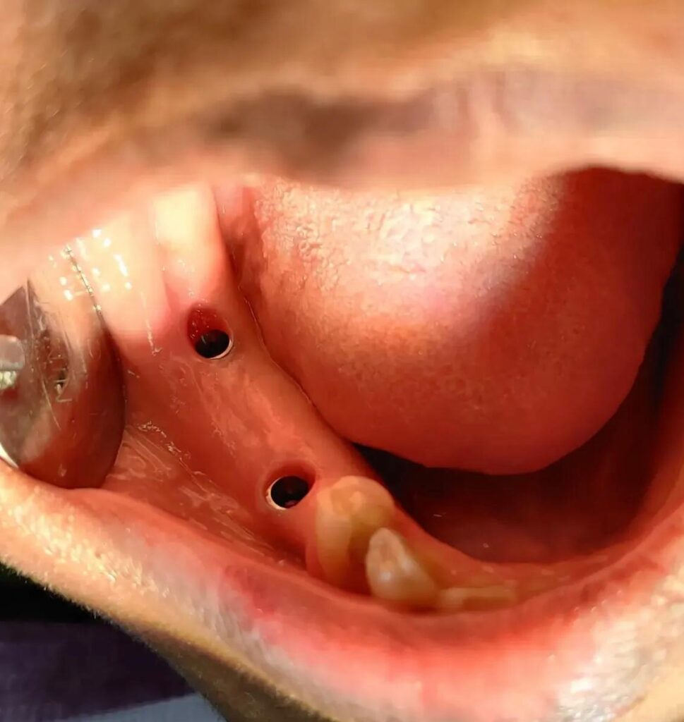 Implants in Wakad, PCMC Dr mayank patil elite smile dental clinic