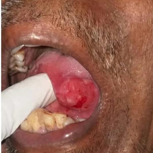 Oral Cancer Treatment in Wakad, PCMC De. Patil Elite Smile Dental Clinic