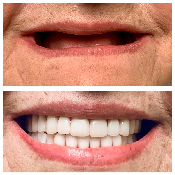 complete dentures in wakad at dr, patils elite smile
