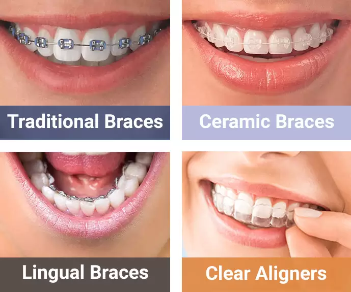 braces-aligners-wakad-dr.patils elite smile dental clinic