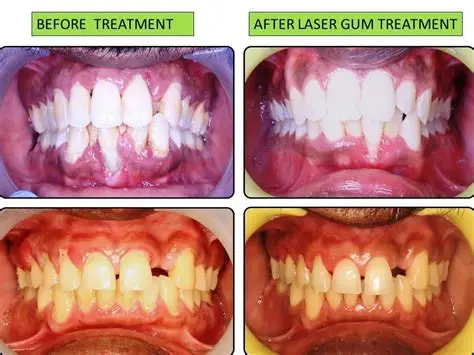 laser treatment in wakad