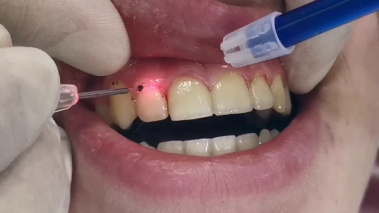 laser treatment in wakad at dr.patils elite smile dental clinic