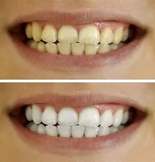 teeth whitening in wakad at dr.patils elite smile clinic