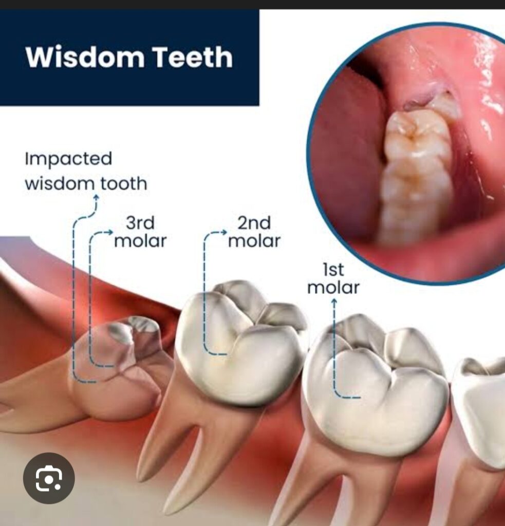 wisdom tooth extraction ewakad dr.patils elite smile dental clinic